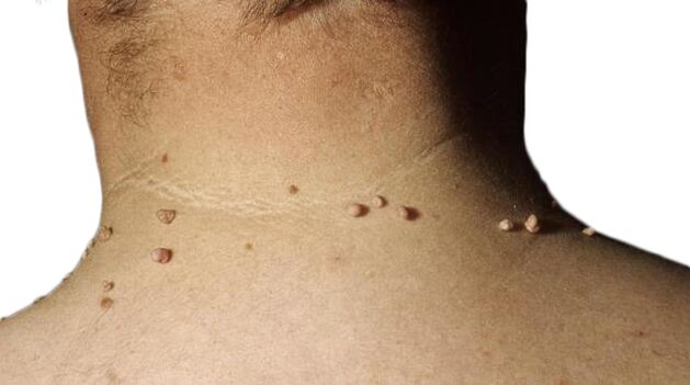 Papilomas no pescoço - uma consequência da derrota do vírus