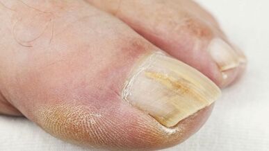 O estágio inicial do desenvolvimento do fungo nas unhas
