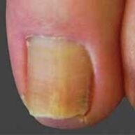 infecção das unhas por dermatófitos