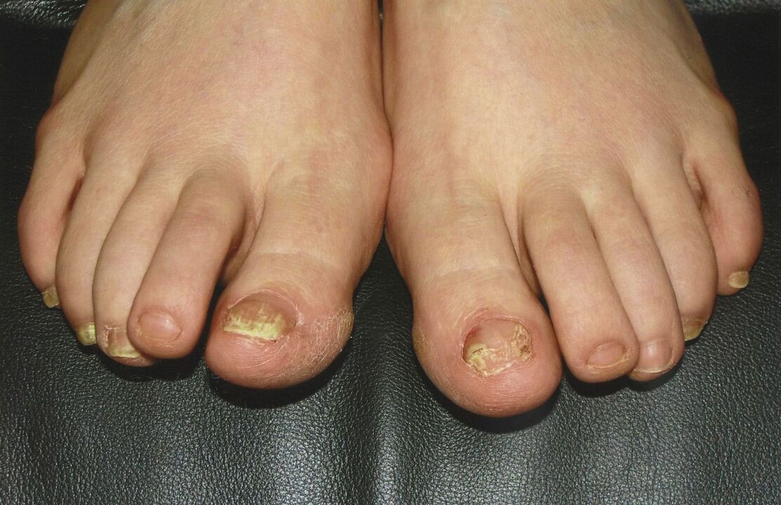 como tratar fungos nas unhas com esmalte