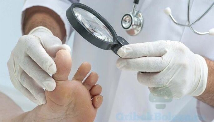 diagnóstico de fungo nos pés por um médico