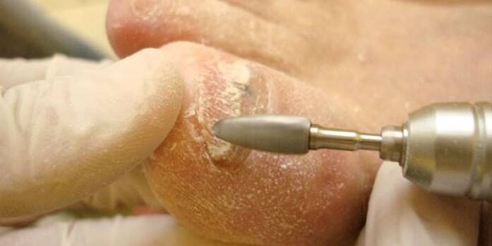remoção de fungos nas unhas