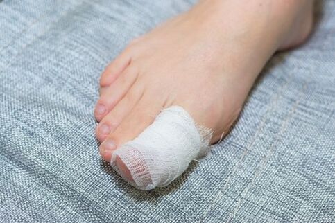 Loção de vinagre de maçã para fungos nas unhas