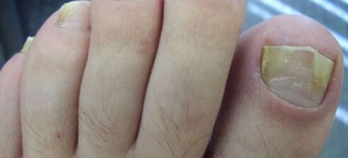 sintomas de fungos nas unhas e seu tratamento com vinagre