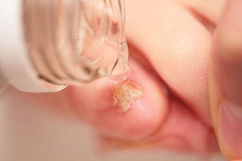 vinagre de maçã para fungos nas unhas