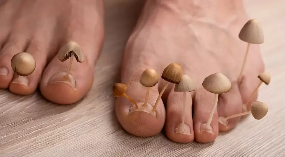 Infecção fúngica que afeta as unhas dos pés