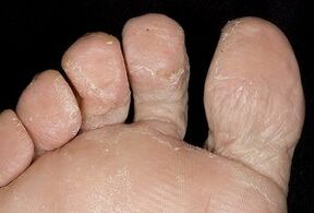 A pele dos pés com infecção fúngica