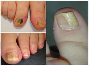 Aparência das unhas dos pés com onicomicose