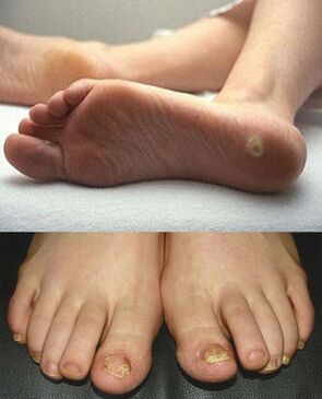 Manifestações de micose na pele e unhas dos pés