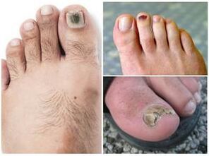 Sinais de infecção fúngica nas unhas dos pés
