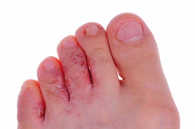 Sintomas de rubrofitose - rachaduras e escamas na pele das pernas