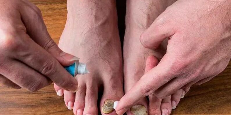 causas de fungos entre os dedos dos pés