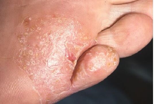 Manifestações de uma infecção fúngica na pele do pé